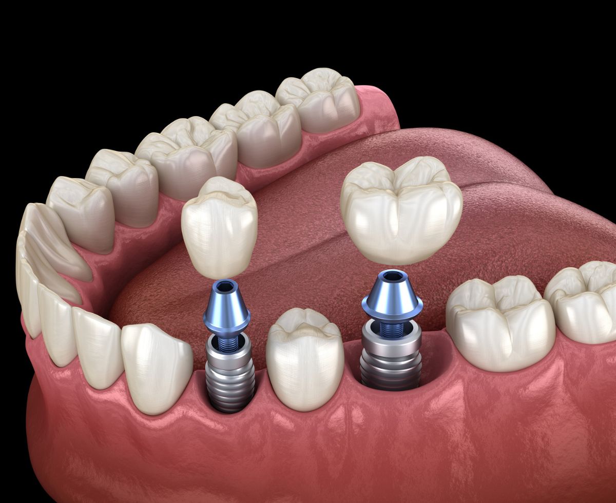 Multiple Tooth Replacement in Vancouver - Hastings Dental Center