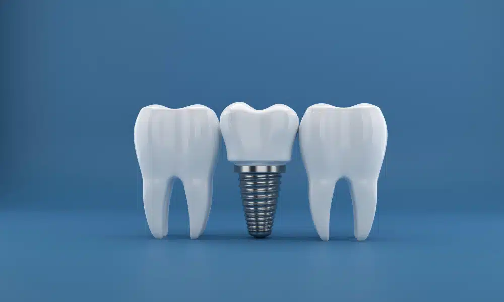 How Long Does an Implant Las