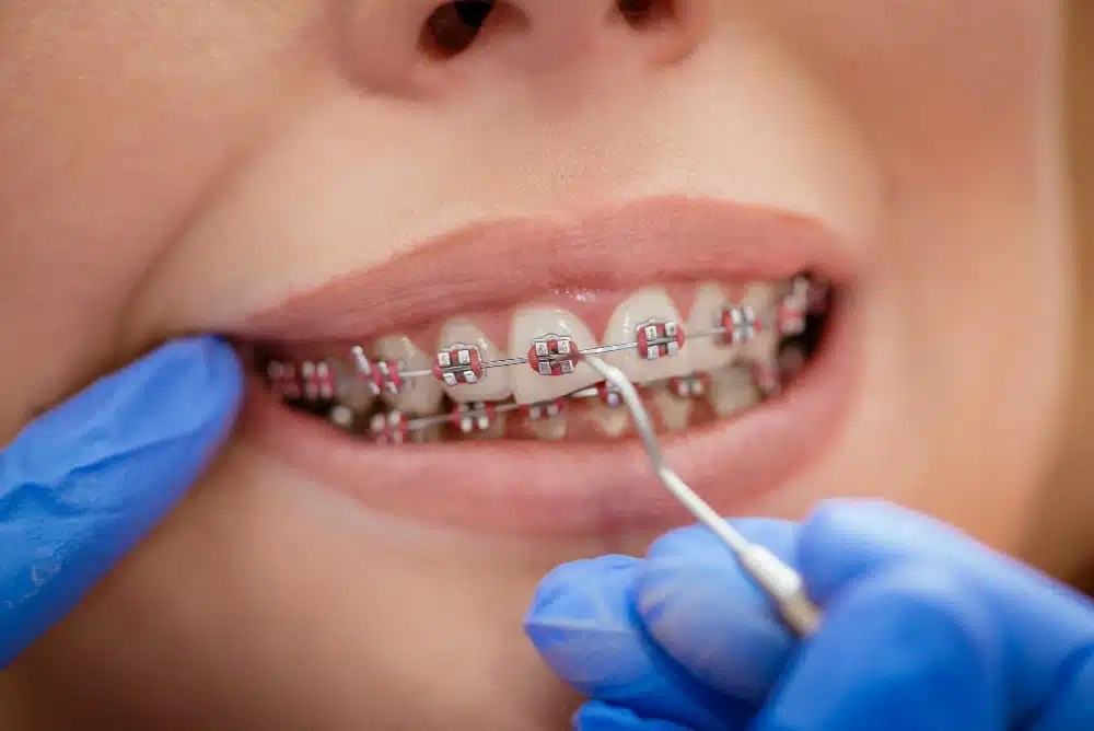 Difference Between Braces and Invisalign